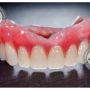 Зубні протези: види та критерії вибору (новини компаній)