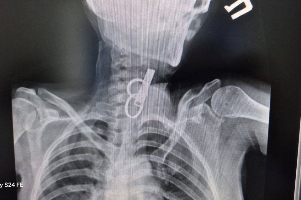 У Гусятині лікарі витягли зі стравоходу жінки ключ від дверей