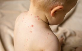 На Тернопільщині зафіксували спалах кору