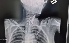 У Гусятині лікарі витягли зі стравоходу жінки ключ від дверей