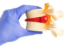 Лікування грижі без операції: коли консервативний шлях має сенс, а коли ні (на правах реклами)