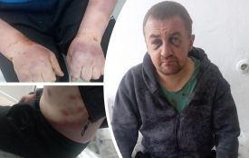 Понад місяць був у лікарні після відвідин ТЦК. Розбіжності у справі побиття мешканця Почаєва